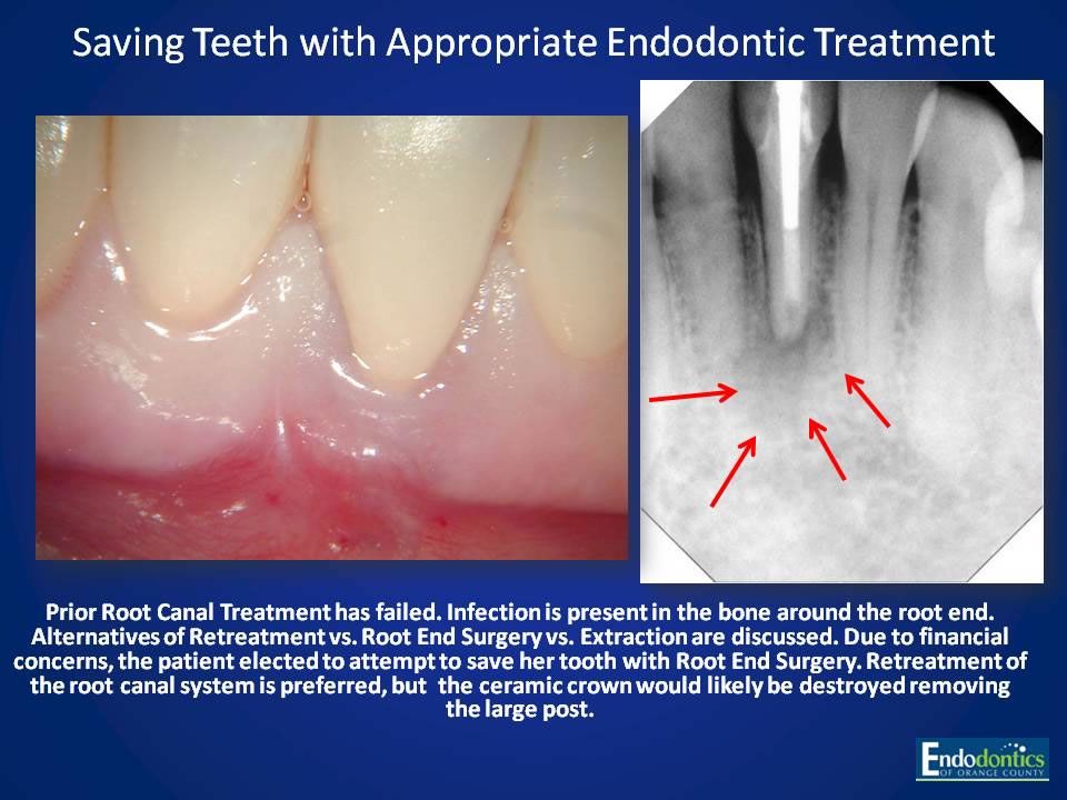 Successful Endodontic Cases Irvine, CA Endodontics of Orange County